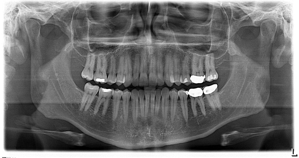 dental x-ray for Root Canal Treatment