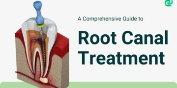 Root Canal Treatment