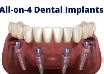 All-on-4 Dental Implants