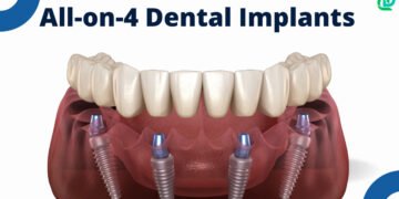 All-on-4 Dental Implants