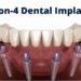 All-on-4 Dental Implants