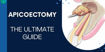 Apicoectomy