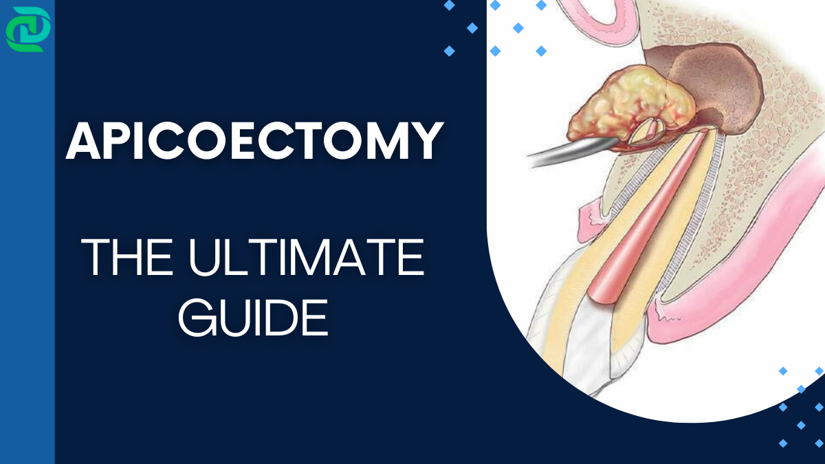 Apicoectomy: Benefits, Risks, Success Rate and Alternatives