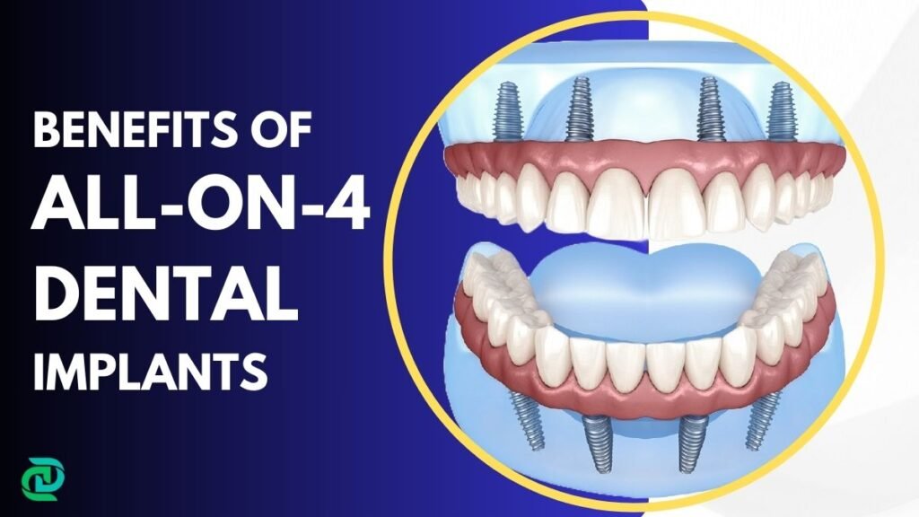 Benefits of All-On-4 Dental Implants