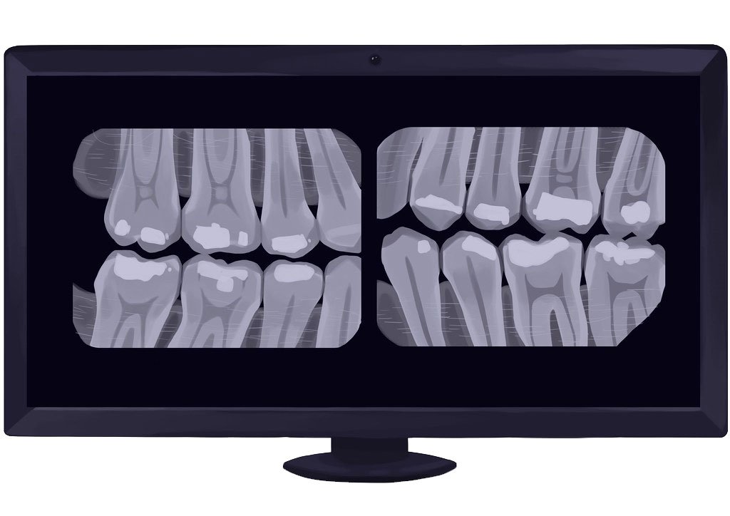 Bitewing X-Rays