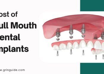 Cost of Full Mouth Dental Implants