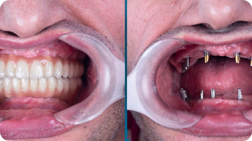 Full Mouth Dental Implants Real Patient Case