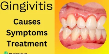 Understanding Gingivitis: Causes, Symptoms, and Treatment