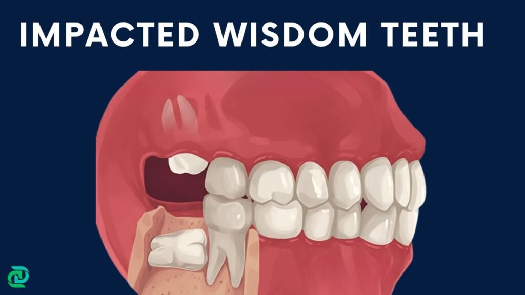 Impacted wisdom teeth leads to tooth and jaw pain