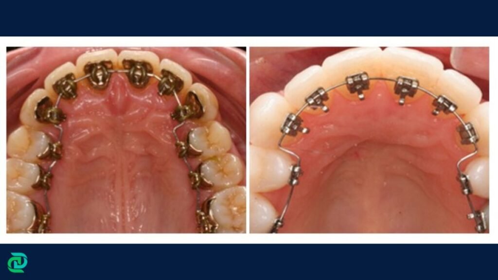 Lingual Braces