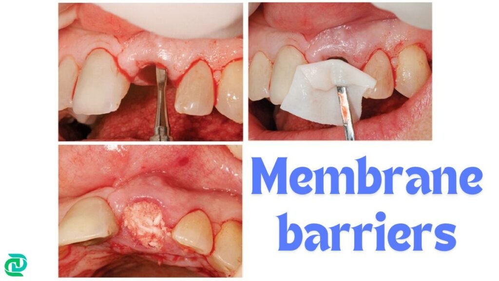 Membrane barriers