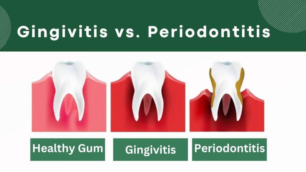 Gingivitis vs. Periodontitis