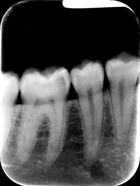 Periapical X-Rays