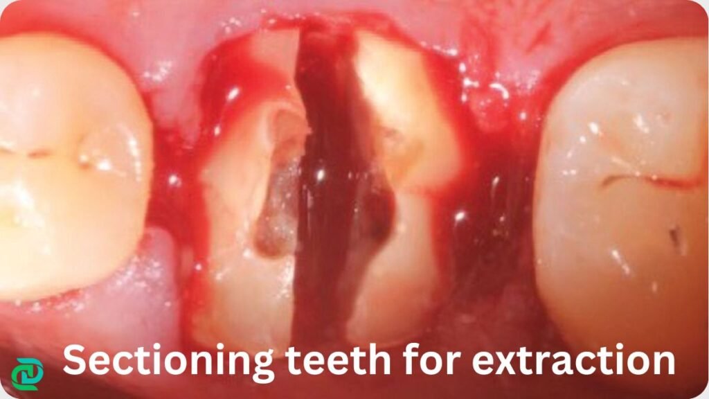 Sectioning teeth for extraction