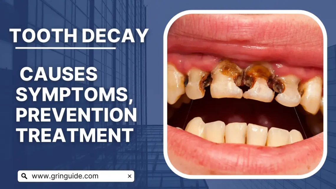 Tooth Decay: Causes, Symptoms, Prevention, and Treatment