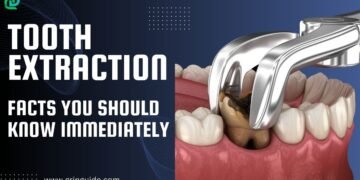 Tooth Extraction Facts you should know immediately