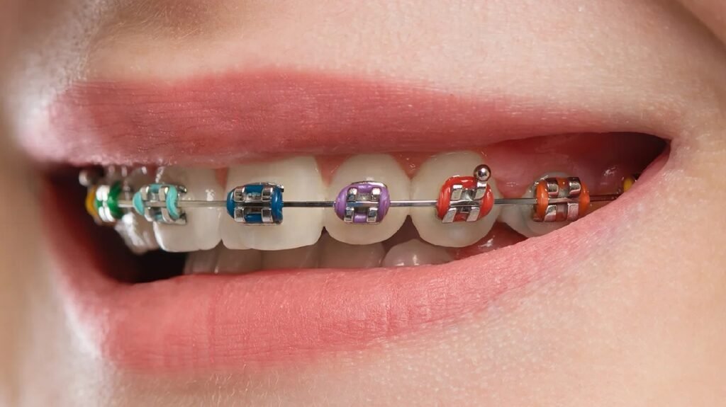 Traditional Metal Braces