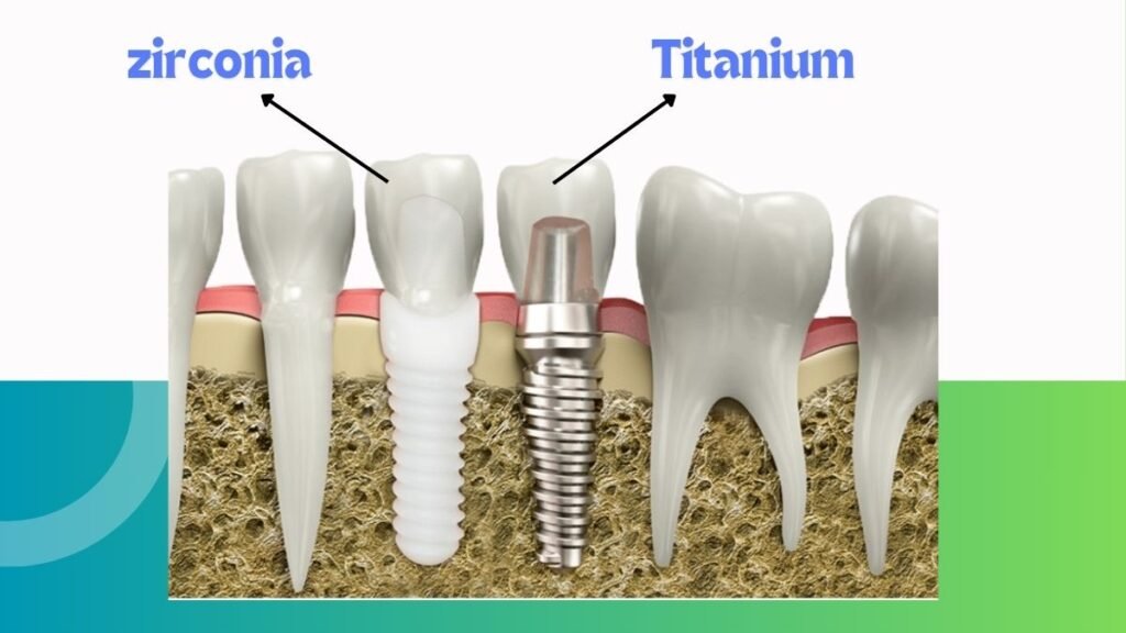 Type of Implants