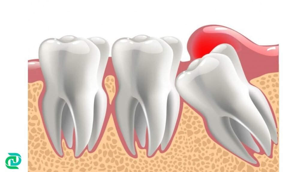 Understanding Wisdom Tooth Pain