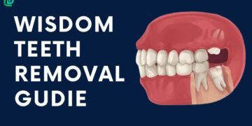 Wisdom Teeth Removal: A Step-By-Step Survival Guide 4 Wisdom Teeth Removal