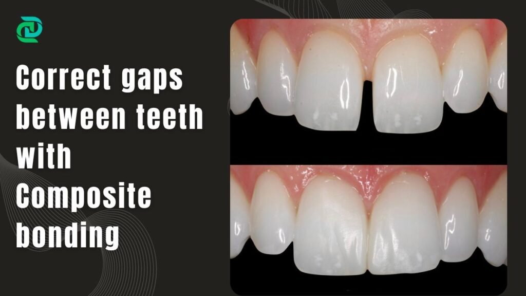 Correct gaps between teeth with Composite bonding