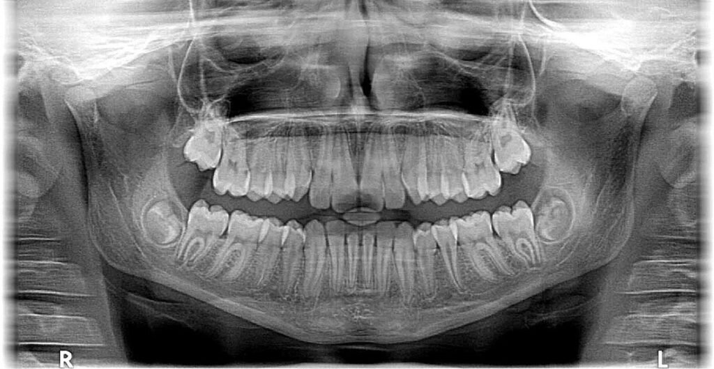 dental x-ray panoramic