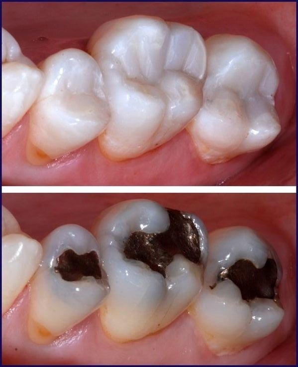 Amalgam Filling vs. Composite Filling