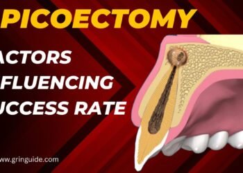 Apicoectomy Success Rate