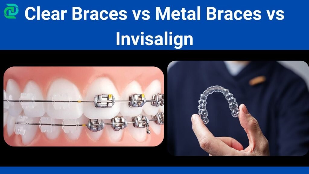 Clear Braces vs Metal Braces vs Invisalign to correct malocclusion