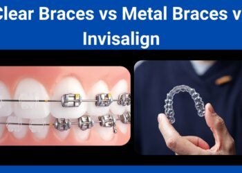 Clear Braces vs Metal Braces vs Invisalign to correct malocclusion