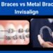 Clear Braces vs Metal Braces vs Invisalign to correct malocclusion