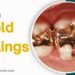 Gold Fillings Pros Cons Value and Cost