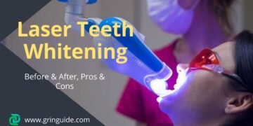 Laser Teeth Whitening