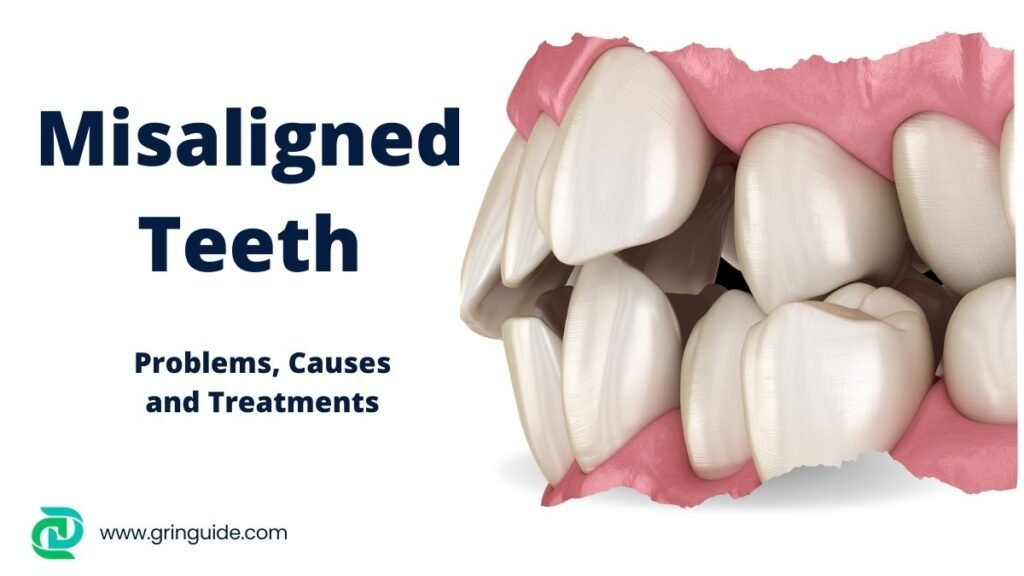 Misaligned Teeth 