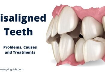 Misaligned Teeth