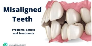 Misaligned Teeth