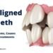 Misaligned Teeth