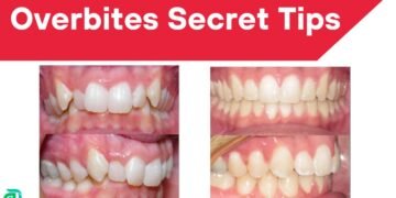 Overbites Secret Tips