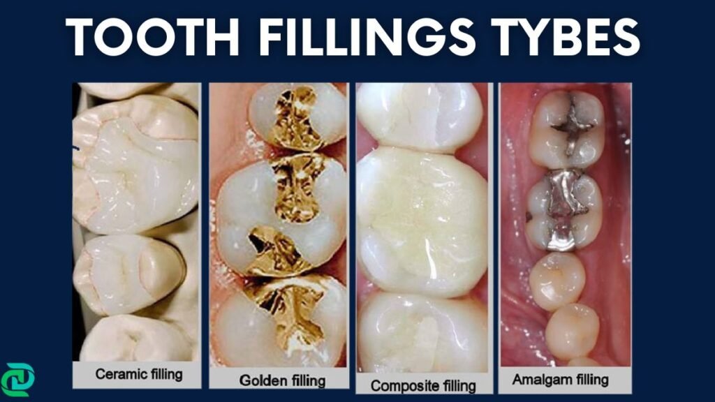 Tooth Fillings types