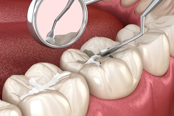 dental sealants for treatment of tooth sensitivity