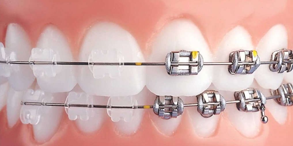 Clear Braces vs Metal Braces