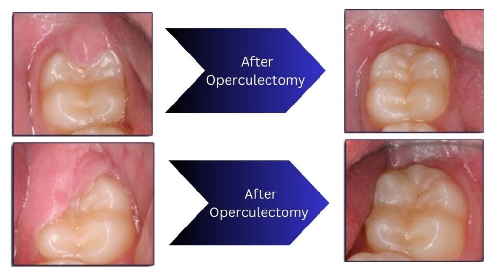 operculectomy for Pericoronitis Pain Unbearable