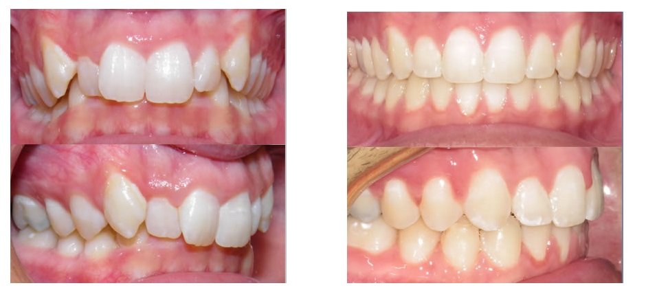 overbite before and after braces