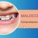 Malocclusion