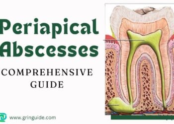 Periapical Abscesses