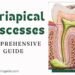 Periapical Abscesses