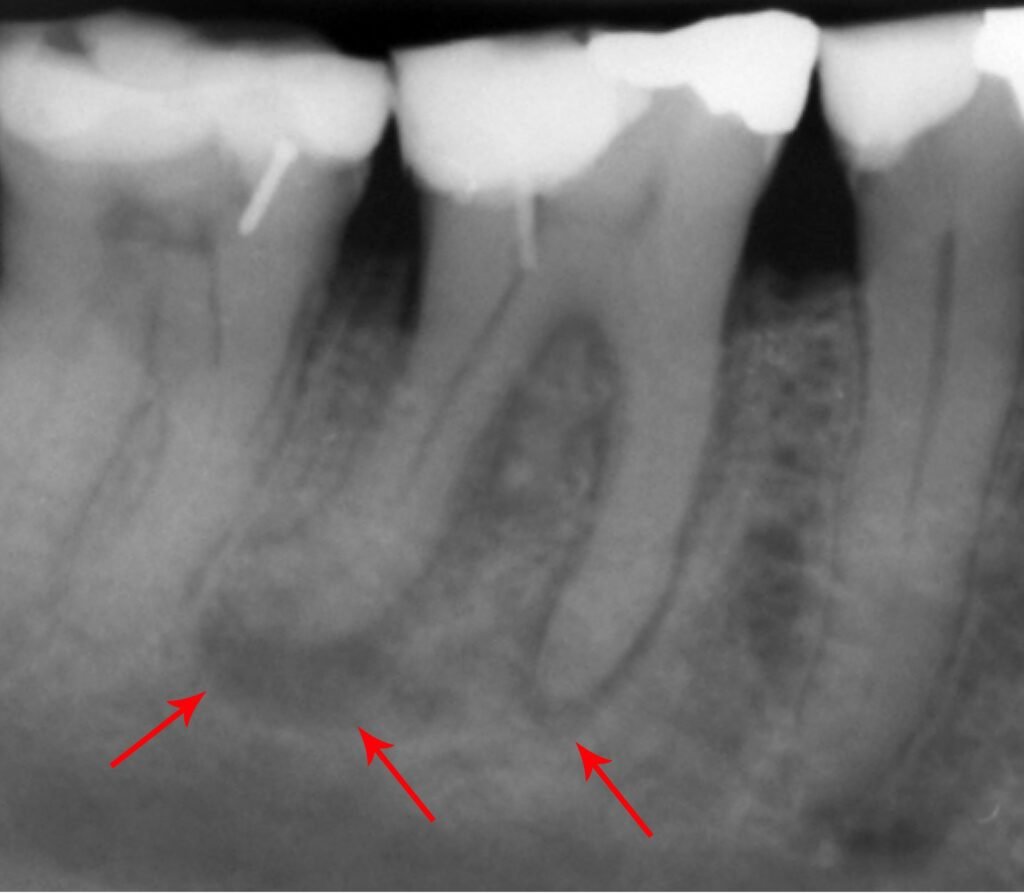 Periapical Abscesses Radiology