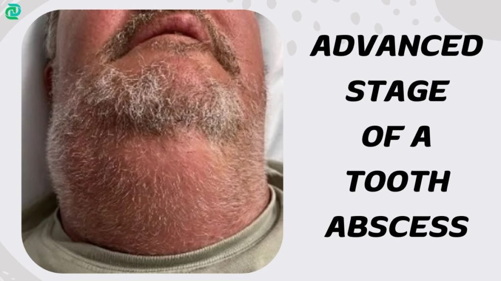 Advanced Stage of a Tooth Abscess