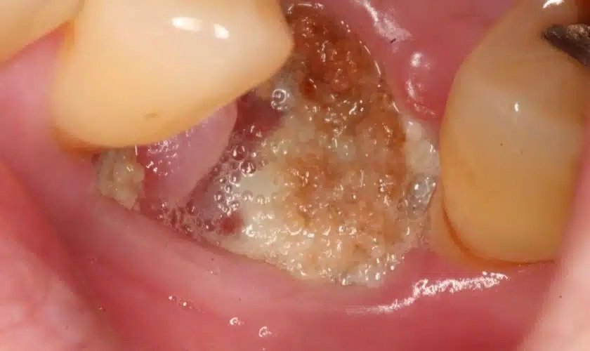 dry socket after infected tooth extraction