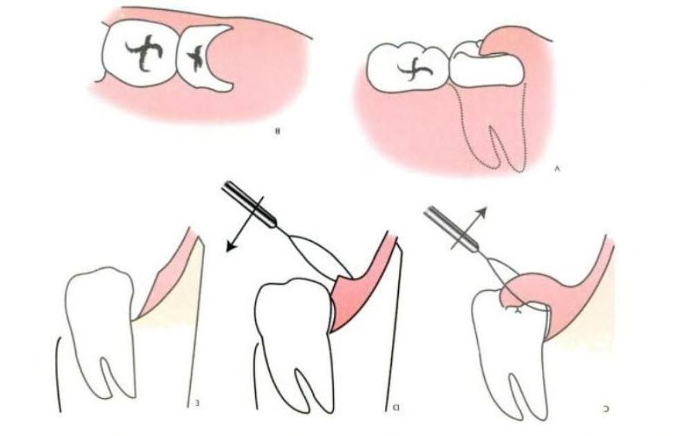 operculectomy is a treatment for Wisdom Tooth Infections